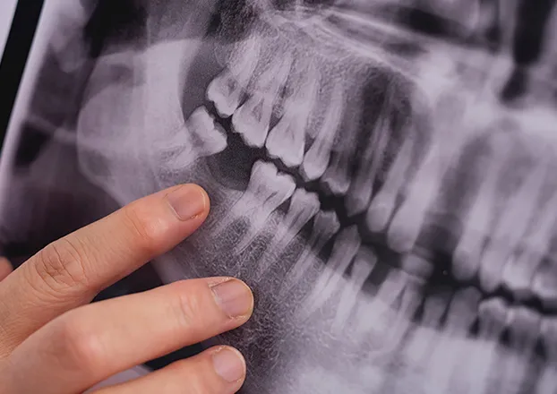レントゲンで黒い影があると診断された