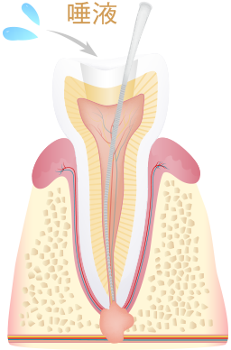 ラバーダム防湿を行わない場合