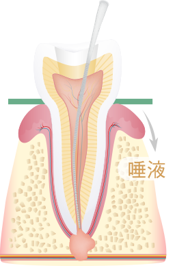 ラバーダム防湿を行った場合