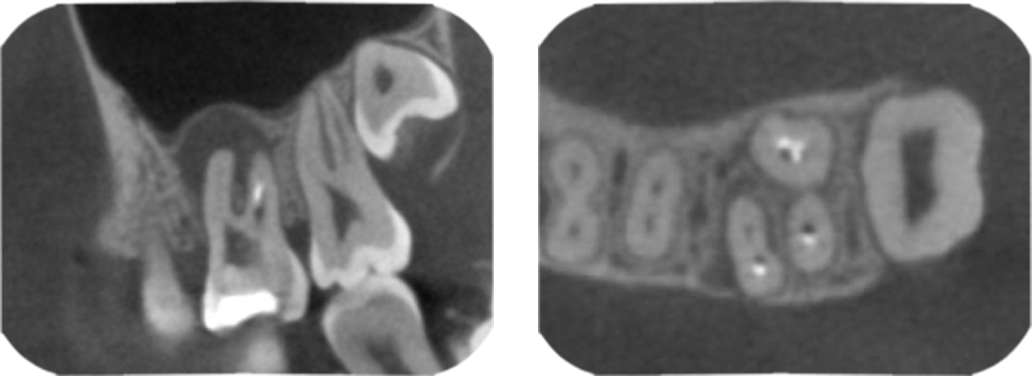 根管の構造を立体的に捉える歯科用コーンビームCTで根管の隅々まで把握する