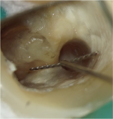 根管内の異物除去