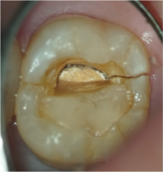 歯根破折の確認