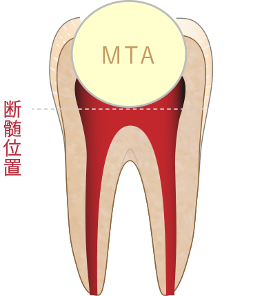 部分断髄法（MP）