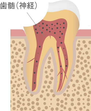 不可逆性歯髄炎
