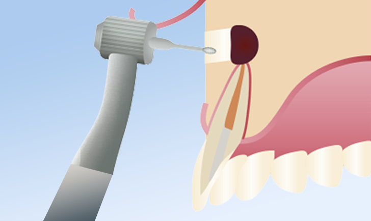 歯内療法外科だからできる難症例対応